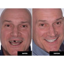 [PROMOÇÃO MÊS DO CONSUMIDOR] Lentes de Resina Dental White© - COMPRE E LEVE O KIT SUPERIOR E INFERIOR + BRINDE